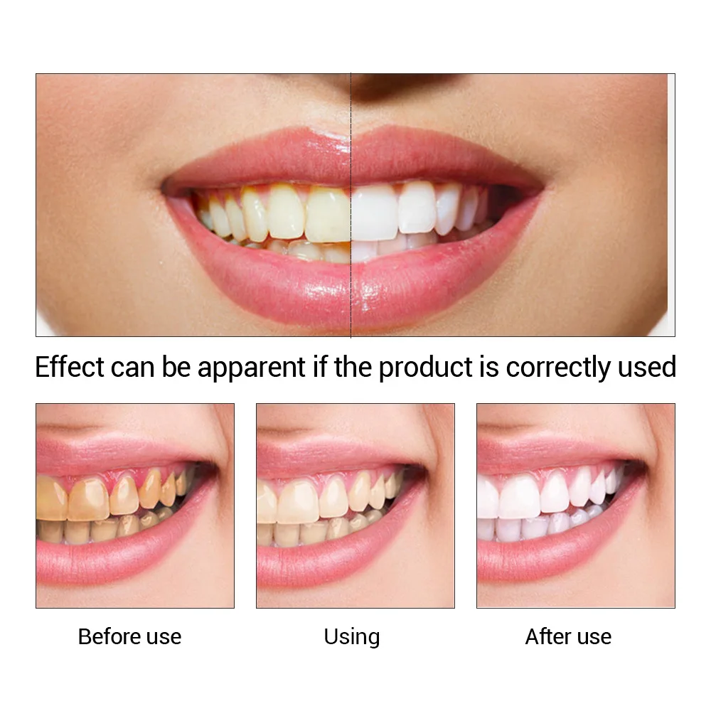 FTEENPLY Zahnaufhellung Essenz – Teeth Whitening Zimba Bewertung und Preis