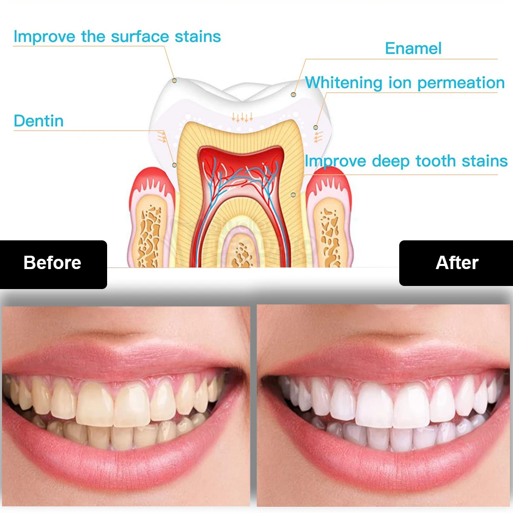 Dental Zahnaufhellung Kit Mini – Teeth Whitening Light Kit Bewertung und Preis